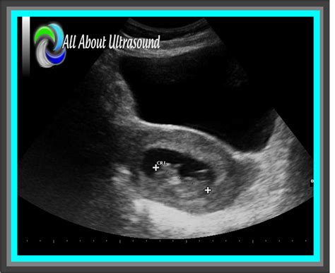 5 Best Practice Tips To Ob Gyn Ultrasound