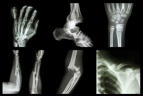 How To Know If A Bone Is Broken Elite Medical Center