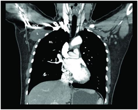 Chest Ct With Intravascular Contrast Coronal View L Open I