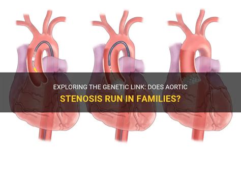 Exploring The Genetic Link Does Aortic Stenosis Run In Families Medshun