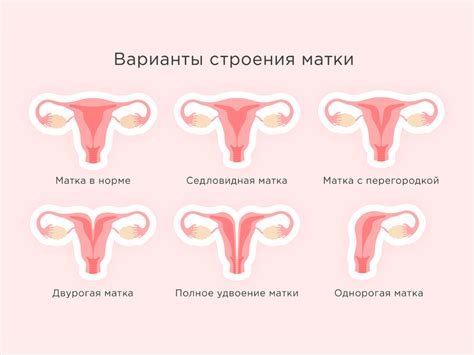 Патологии матки как с ними родить и забеременеть Иркутский городской перинатальный центр