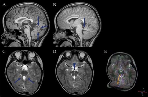 Magnetic Resonance Imaging Findings In A Patient With Joubert Syndrome