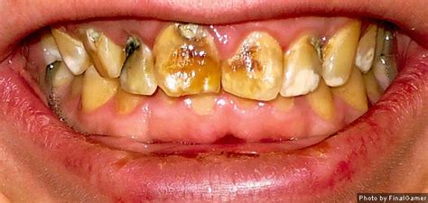 Dental Fluorosis Too Much Fluoride Stains Teeth Oral Answers