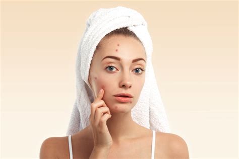 How You Can Control Your Acne Breakouts Health Hyme