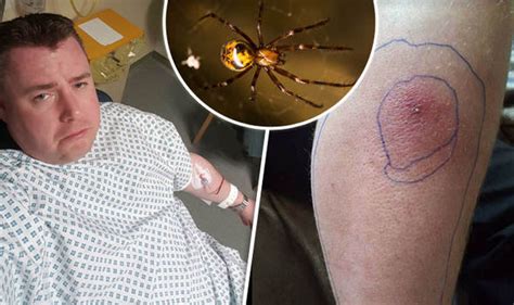 False Widow Invasion Spider Bite Lands Father In Hopsital Uk News Uk