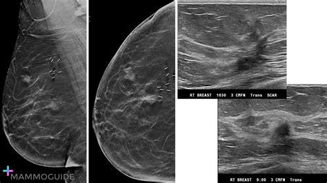 Subareolar Abscess Pictures