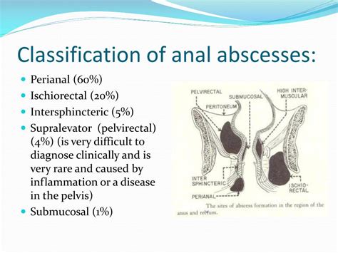 abscesses and fistulas caption diagram showing the location of riset