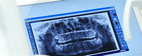 Die keime können sich bis in die pulpa ausbreiten, in der die nerven und blutgefäße verlaufen. Wurzelbehandlung am Zahn | Wissenswertes Endodontie | 360°zahn