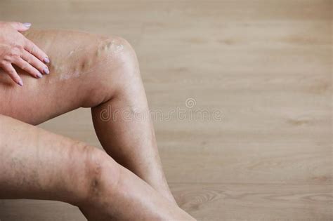 Painful Varicose And Spider Veins On Female Legs Woman Massaging Tired Leg Stock Image Image