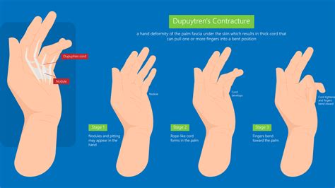 Dupuytrens Contracture Symptoms Causes And Treatments Advanced