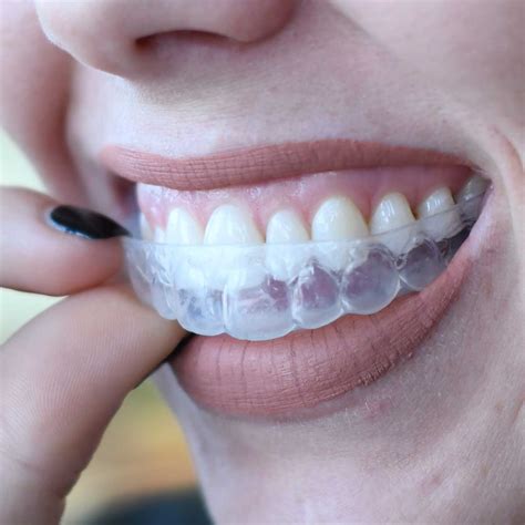 Teeth Treat Teeth Whitening At Home With Trays