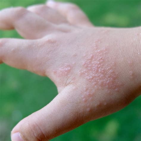 10 Novel Treatments For Chronic Itch Eczema And Skin Infections Suzy