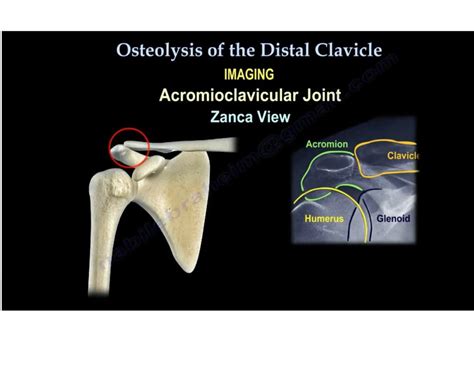 Osteolysis Of The Distal Clavicle —