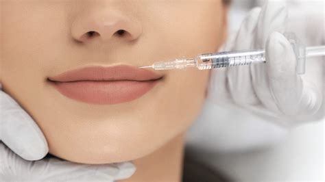 aumento y perfilamiento de labios Ácido hialurÓnico regenera skin