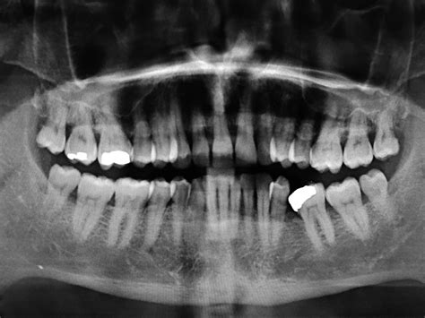 Oral Maxillary Exostosis Limongelli 2019 Clinical Case Reports