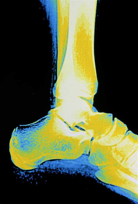 X Ray Of Ankle Bones In The Human Foot Photograph By Gcascience Photo