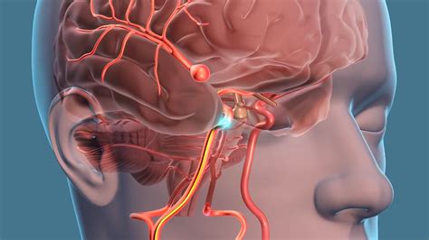 If the person didn't lose consciousness, they have a better chance of responding well to treatment. If Your Relative Has an Aneurysm, You Might Have One Too ...