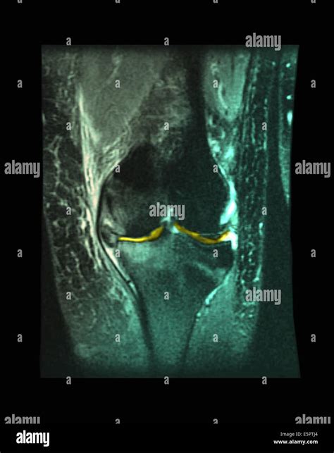 Sagittal Frontal Magnetic Resonance Image Mri Of The Knee Showing