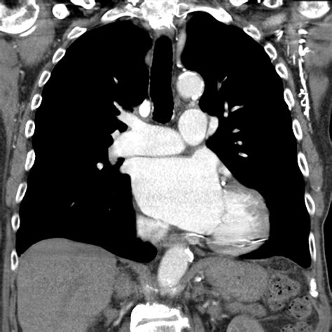 Pulmonary Adenocarcinoma Image