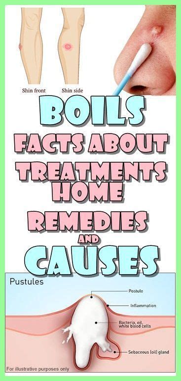 Boils Facts About Treatments Home Remedies And Causes Home Remedies