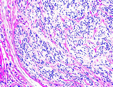 Pathology Outlines Palisaded Encapsulated Neuroma