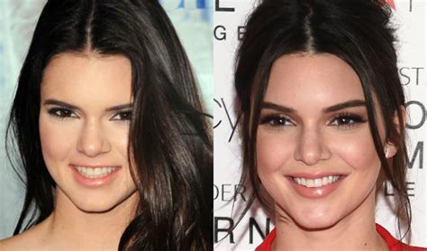 Let's see how her appearance and styles have. Kendall Jenner Plastic Surgery - ipbs