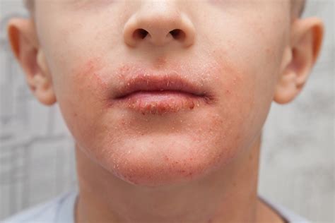 Eczema Face
