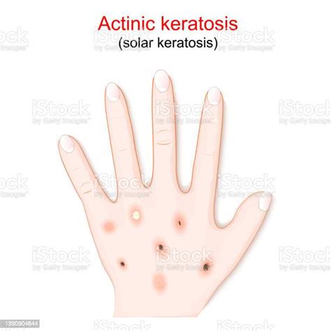 Actinic Keratosis Solar Keratosis Stock Illustration Download Image