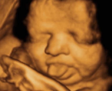 Picture perfect 3d/4d ultrasound imaging. 3D/4D Ultrasound Experience