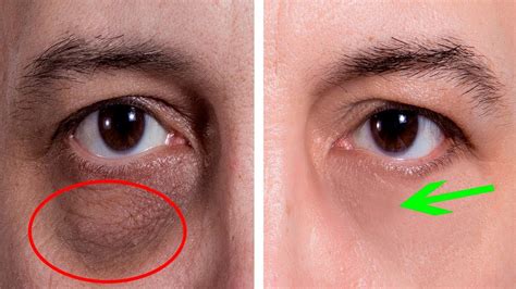 Dark Circles Under Eyes Causes Liver