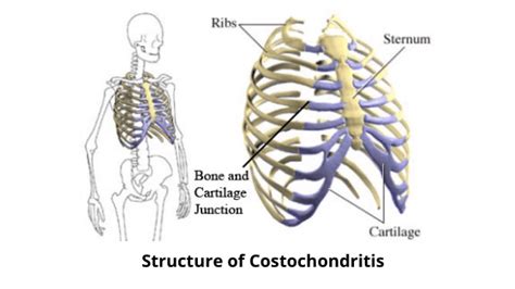 Costochondritis List Of Causes Symptoms And Treatment