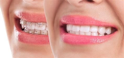 Know The Ways Of Teeth Whitening While Wearing Braces