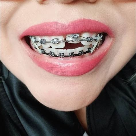 Braces Girlswithbraces Metalbraces Elastics Powerchain Springs