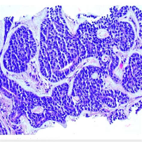 Right Lower Lobe Lung Nodule Biopsy Adenoid Cystic Carcinoma