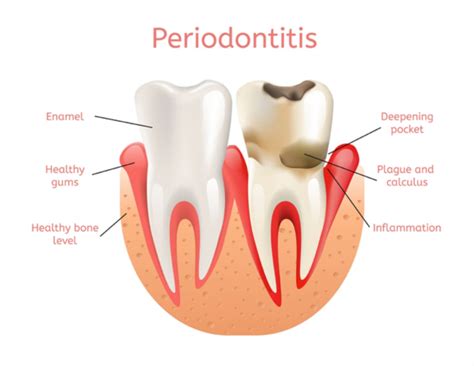 Periodontitis And Gum Disease Treatment Auckland Primecare Dental