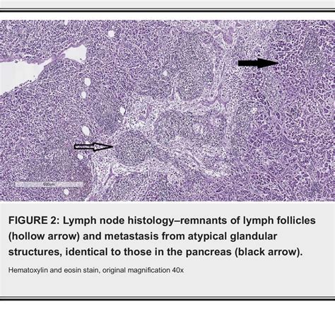 Figure 2 From Thrombophlebitis Migrans Trousseau Syndrome In