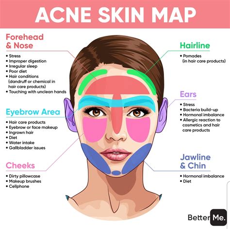 Acne Face Map Causes Of Breakouts Face Mapping Acne Face Acne Face