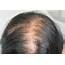 How To Prevent Dry Scalp Hair Loss – Royal Formula