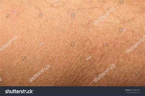 Dry Skin Ichthyosis Detail Stock Photo 160854104 Shutterstock