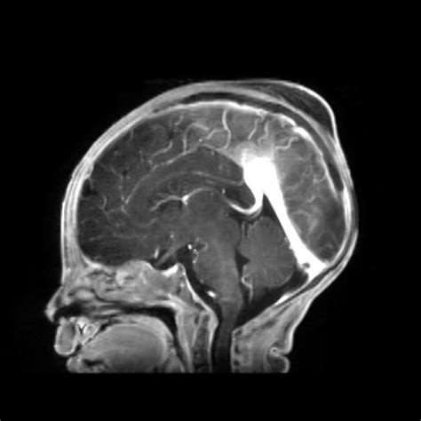 Extensive Filling Defects Can Be Seen Along The Superior Sagittal Sinus