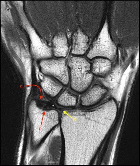 Displaced Triangular Fibrocartilage Cartilage Complex Tears Radsource