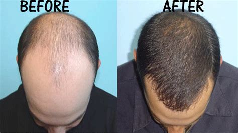 10 Best Effective Treatments For Thinning Hair Or Hair Loss Youtube