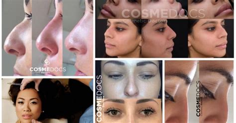 Unlocking Radiant Skin A Guide To Nose Dermal Fillers And Skincare