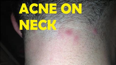 How To Get Rid Of Acne On Back Of Neck Youtube