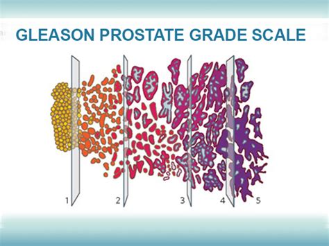 Prostate Cancer Stage