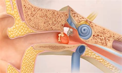 What Is Cholesteatoma Knox Audiology Knox Hearing Clinics