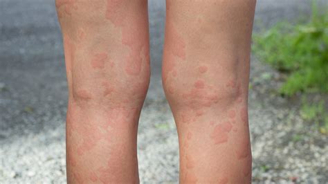 Hives Skin Rashes Itchy