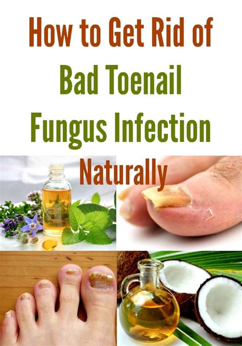How To Get Rid Of Bad Toenail Fungus Infection Naturally Nail Fungus