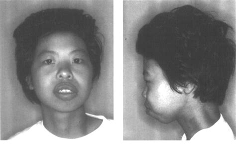 Fortunately, the williams syndrome association (wsa) became their base of knowledge to better williams syndrome center. The patient with Williams syndrome, Note the high and ...