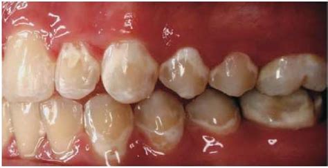 Pdf White Spot Lesions In Orthodontics Incidence And Prevention